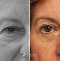 Blefaroplastia - Dr. José María Triviño Fernández