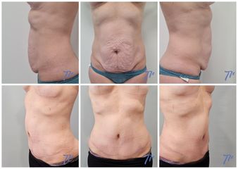 Abdominoplastia - Dr. José María Triviño Fernández