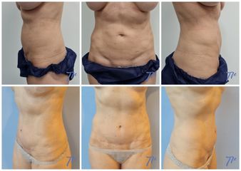 Abdominoplastia - Dr. José María Triviño Fernández