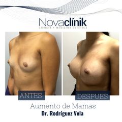 Aumento de pecho - NovaClínik