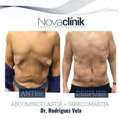 Abdominoplastia + Ginecomastia - NovaClínik