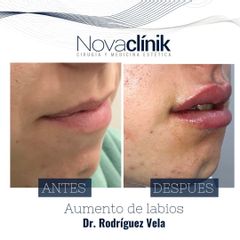Aumento de labios - NovaClínik