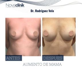 Aumento de pecho - NovaClínik