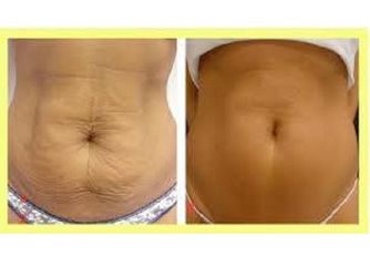 Antes y después Abdominoplastia