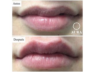 Aumento labios - 650876