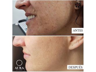 Tratamiento antimanchas - 650880
