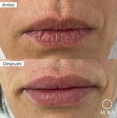 Antes y después Aumento de labios - Aura Clínica