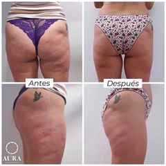 Antes y después Mesoterapia - Aura Clínica