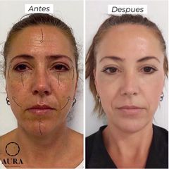 Antes y después Ácido hialurónico - Aura Clínica