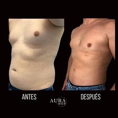 Liposucción + Marcación Abdominal - Aura Men