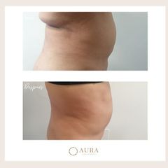 Mesoterapia - Aura Clínica