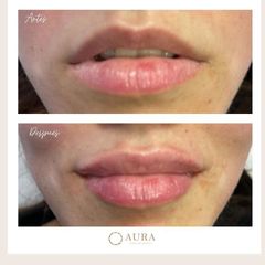 Aumento de labios - Aura Clínica