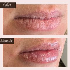 Aumento de labios - Aura Norte