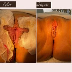 Labioplastia - Aura Norte
