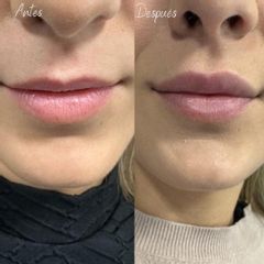 Aumento de labios - Aura Clínica