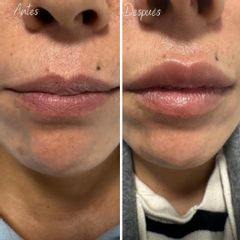 Aumento de labios - Aura Clínica