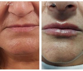 Aumento labios - Aura Clínica