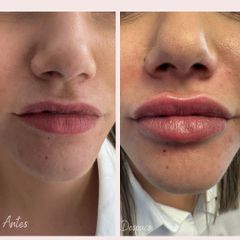 Aumento labios - Aura Norte