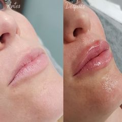 Aumento labios - Aura Norte