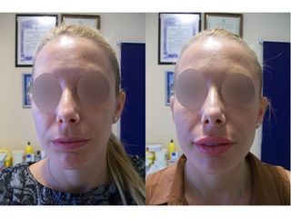 Antes y después Aumento de labios - Dra. Arrom