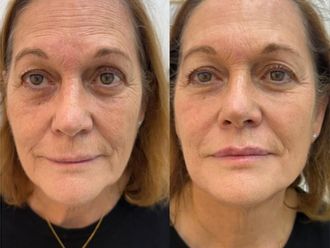 Ácido hialurónico antes y después - 877504