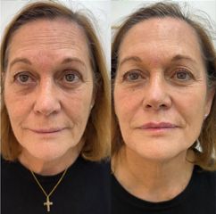 Dra. Paula Catena Medicina Estética - ácido hialurónico e inductores colágeno