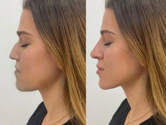 Rinomodelación antes y después - 877505