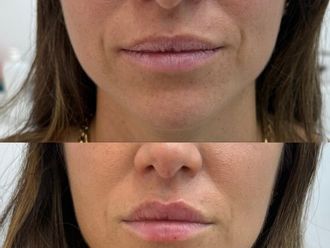 Ácido hialurónico antes y después - 877506