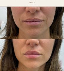 Dra. Paula Catena Medicina Estética - hidratación con ácido hialurónico