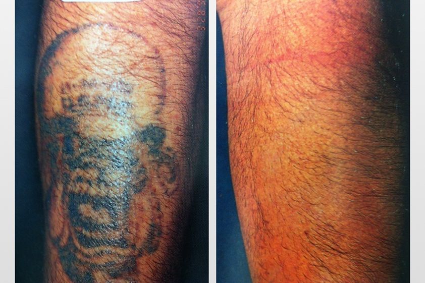 Eliminación de tatuajes antes y después - 299805