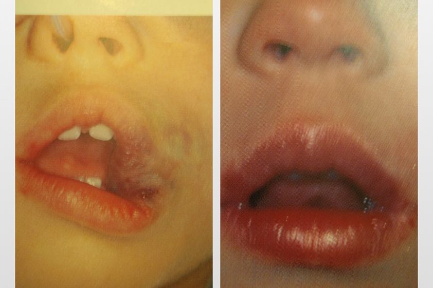 Angiomas antes y después - 299820