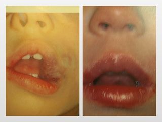 Antes y después Angioma en infante