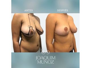 Reducción de senos - Dr. Joaquim Muñoz I Vidal