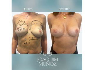 Reconstrucción Mamaria - Dr. Joaquim Muñoz I Vidal