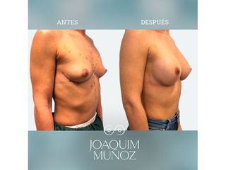 Aumento de pecho - Dr. Joaquim Muñoz I Vidal