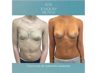 Aumento de pecho - Dr. Joaquim Muñoz I Vidal