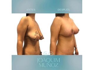 Mastopexia - Dr. Joaquim Muñoz I Vidal