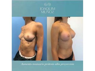 Aumento de pecho - Dr. Joaquim Muñoz I Vidal