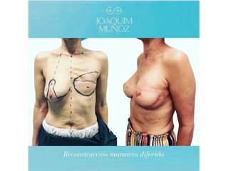 Reconstrucción mamaria - Dr. Joaquim Muñoz I Vidal
