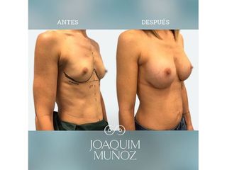 Aumento de pecho - Dr. Joaquim Muñoz I Vidal