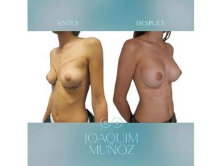 Aumento de pecho - Dr. Joaquim Muñoz I Vidal