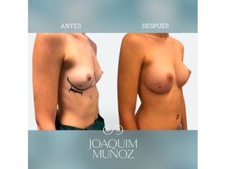 Aumento de pecho - Dr. Joaquim Muñoz I Vidal