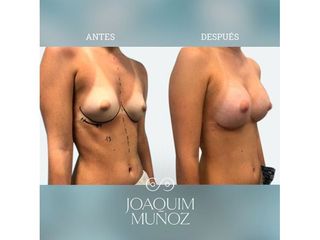 Aumento de pecho - Dr. Joaquim Muñoz I Vidal