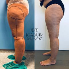 Liposucción - Dr. Joaquim Muñoz I Vidal