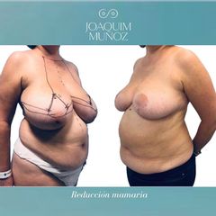 Reducción de senos - Dr. Joaquim Muñoz I Vidal