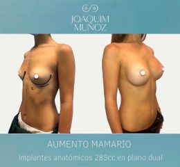 Aumento de pecho - Dr. Joaquim Muñoz I Vidal