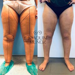 Liposucción - Dr. Joaquim Muñoz I Vidal