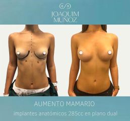Aumento de pecho - Dr. Joaquim Muñoz I Vidal