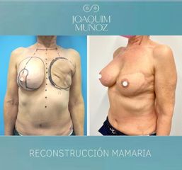 Reconstrucción mamaria - Dr. Joaquim Muñoz I Vidal