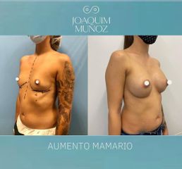 Aumento de pecho - Dr. Joaquim Muñoz I Vidal
